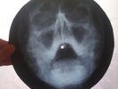 Elvis Presley - Heartbreak Hotel - X-RAY - USSR ROENTGEN BONES RECORD - SKULL