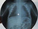 CASTILES BRUCE SPRINGSTEEN - BABY I - USSR GEORGIAN X-RAY ROENTGEN BABY SKELETON