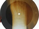 BEACH BOYS - BARBARA ANN - UNIQUE USSR GEORGIAN X-RAY ROENTGEN FOOT BONES RECORD