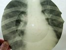 X-RAY 78rpm YURI MORFESSI sings When spring comes again USSR ROENTGEN RIBS 1950s