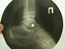 X-RAY 78rpm ELVIS PRESLEY Loving you UNIQUE USSR ROENTGEN BONES Leg Foot 1960s