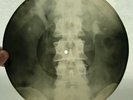 X-RAY 78rpm KATYNA RANIERI Canzone da due soldi USSR ROENTGEN BONES Spine 1950s