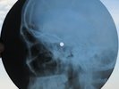 ELVIS PRESLEY - LITTLE SISTER - UNIQUE USSR GEORGIAN X-RAY ROENTGEN SKULL RECORD