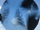 BEATLES - I NEED YOU - USSR GEORGIAN UNIQUE X-RAY ROENTGEN BABY RIBS RECORD