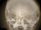 Elvis Presley - Heartbreak Hotel X-RAY BONE OF THE USSR X-RAY RECORDING