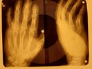 Beatles - All My Loving X-RAY OF USSR X-RAY BONE RECORDING