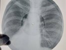X-RAY USSR ROENTGEN BONES RECORD ORIGINAL OLD RIBS 556