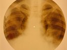 X-RAY USSR ROENTGEN BONES RECORD 78 rpm ORIGINAL OLD RIBS 741