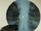 PINK FLOYD FAT OLD SUN X-Ray USSR Record Roentgen Bone Ribs Music Vinyl