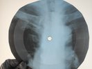 DAVID BOWIE LIFE ON MARS X-Ray USSR Record Roentgen Bone Ribs Music Vinyl
