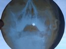 LISTEN  PINK FLOYD -JULIA DREAM-UNIQUE USSR GEORGIAN X-RAY SCULL BONES RECORD