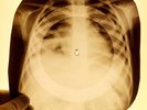 USSR  X-RAY CHILDREN BONES RIBS SOVIET VINTAGE UNIQUE ITEM RECORD 143